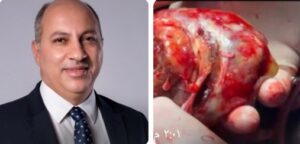 بدعم منظومة الجراحات المتقدمة بقصر العيني.. فريق جراحة القلب ينجح في استئصال ورم نادر بحجم قبضة اليد من قلب مريض سبعيني