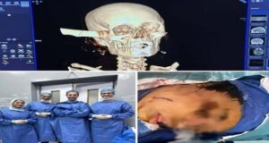 داخل طواري قصر العيني “جامعه القاهرة” فريق طبي متعدد التخصصات ينقذ مريضة شابة في جراحة دقيقة لاستخراج سكين من قاع الجمجمة